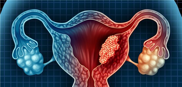 Das Risiko für ein Endometriumkarzinom ist bei Frauen mit einer BRCA-Genmutation 2,8-fach erhöht (3,5-fach für BRCA1; 1,7-fach für BRCA2).