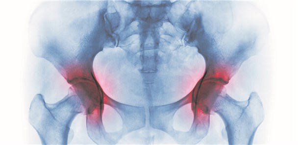 Das Risiko für eine Hüftkopfablösung steigt bei Kindern mit jedem überschüssigen Gramm.