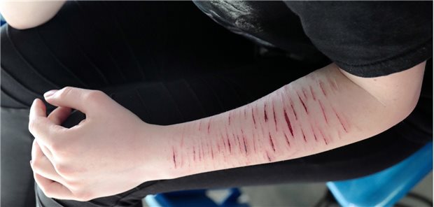 Das „Ritzen“ ist eine der häufigsten Arten der Selbstverletzung bei Jugendlichen.