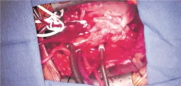 Das Schweineherz ist implantiert – werden sich solche Bilder häufen? Textbaustein: FotohinweisUniversity of Maryland School of Medicine