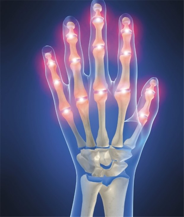 Golimumab wirkt - egal, welche Vortherapie Das Skelett einer Hand zeigt die für Rheumatoide Arthritis typischen Schmerzpunkte.