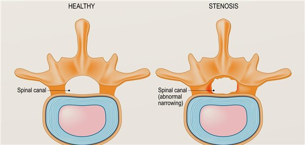 Das Studienteam um Thomas Karlsson resümiert, dass die Hinzunahme der Spondylodese zur Dekompression in der operativen Therapie der Spinalkanalstenose auf fünf Jahre gesehen keine Vorteile mit Blick auf den Oswestry Disability Index bringt. 