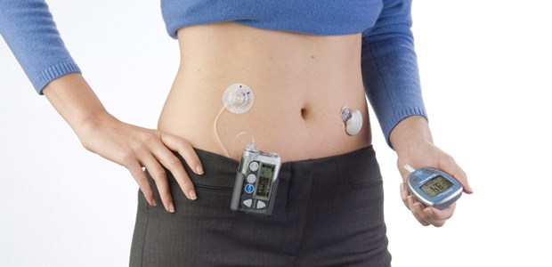 Insulinpumpe erkennt Hypoglykämien Das System Veo mit Insulinpumpe und Sensor am Körper.