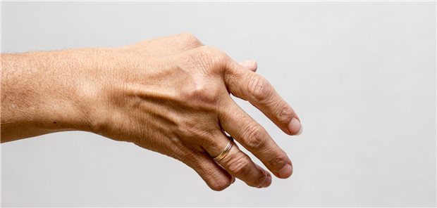 Das Team der Universität Pisa resümiert, dass Risikofaktoren für Organschäden nach einem Jahr bei undifferenzierter Kollagenose das Alter bei den ersten Symptomen und das Alter bei Diagnose waren. Immunsuppressiva zu erhalten und keine Antimalariamittel einzunehmen, erhöhte das Fünf-Jahres-Risiko für Organschäden. 