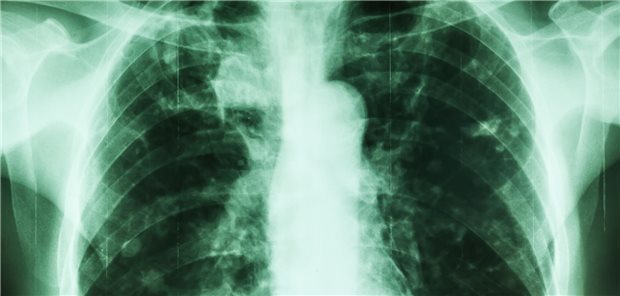 Röntgenaufnahme eines Brustkorbs