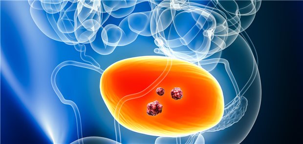 Das Team um Lucas Kastner resümiert, dass Chemohyperthermie durch den Einsatz von HIVEC in hohen Raten an Rezidivfreiheit, einer Progressionsfreiheit über zwei Jahre von 98 Prozent und einem Blasenerhalt von nahezu 80 Prozent resultiert.