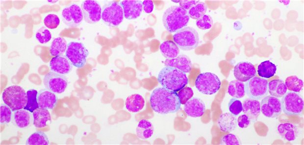 Das Team um Professor Andreas Hochhaus resümiert, dass die Resultate ihrer Studie letztlich für eine ähnliche, wenn nicht bessere Wirksamkeit von Asciminib verglichen mit Zweitgenerations-TKI in der Erstlinie bei einer besseren Verträglichkeit sowie einer besseren Tumorkontrolle sprechen. Der STAMP-Hemmer könnte daher das Nutzen-Risiko-Profil einer Erstlinien-CML-Therapie deutlich verbessern.