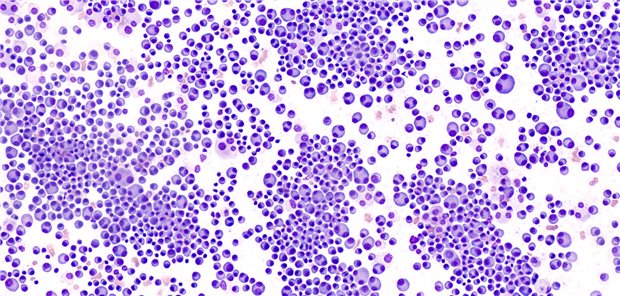 Das Team um Professor Philippe Moreau resümiert, dass unabhängig von der zweiten Randomisierung Betroffene mit der Quadrupeltherapie D-VTd rund 31 Monate länger progressionsfrei leben als solche ohne den Antikörperzusatz. Am längsten war das progressionsfreie Überleben mit D-VTd plus Erhaltungstherapie. 