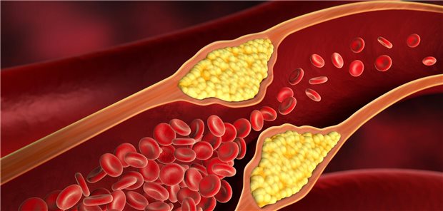 Das Team von Alexander Razavi fand eine deutliche dosisabhängige Assoziation speziell zwischen der Koronarkalk-Last in der linken Koronararterie (LCA-CAC) und der mit atherosklerotischen Erkrankung des Herz-Kreislauf-Systems assoziierten Mortalität. Ab einem LCA-CAC-Score von 100 war das Risiko um relative 55 Prozent erhöht, ab Werten von 300 (schwere Verkalkung) um den Faktor 2,32.