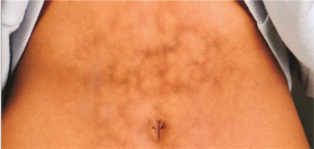 Das Toasted-Skin-Syndrom auf dem Abdomen einer jungen Frau, die über vier Wochen regelmäßig eine heiße Wärmflasche gegen Bauchschmerzen genutzt hatte.