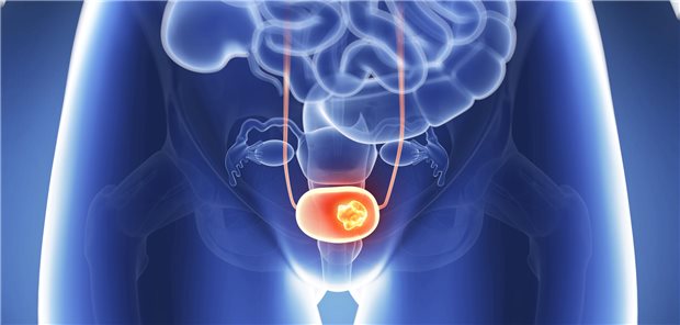 Das Urothelkarzinom gehört zu den häufigen malignen Tumoren. Männer sind in der Regel dreimal häufiger betroffen als Frauen. 