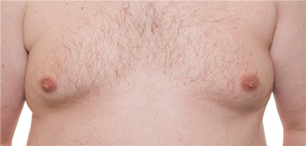 Das Vorhandensein einer idiopathischen Gynäkomastie ist ein wichtiges erstes Symptom einer Grunderkrankung und ein signifikanter Prädiktor für das zukünftige Krankheitsrisiko.