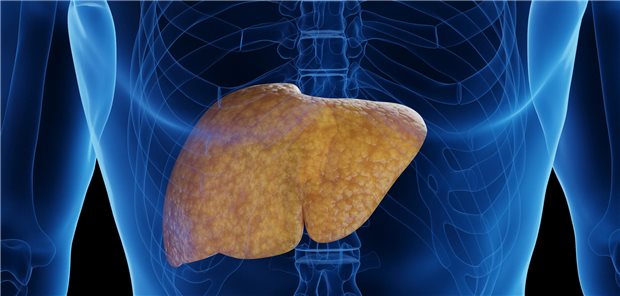 Das Vorliegen einer NAFLD (nichtalkoholische Fettleber) wurde mithilfe des NAFLD-Index beurteilt, der anhand des Body-Mass-Index, des Taillenumfangs, der Triglyzerid- und Gamma-GT-Werte die Wahrscheinlichkeit in Prozent angibt.