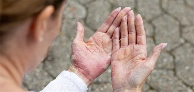 Eine Frau schaut sich ihre Handinnenflächen an, die vom Ekzem gerötet sind.