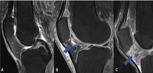 Das der Kniescheibe benachbarte Fett-Polster („Hoffa’s fat pad“, „infrapatellar fat pad“) gibt ein anderes MRI-Signal, wenn das Kniegelenk entzündet ist: (A) Normales Knie ohne Zeichen von Inflammation, (B) Umschriebener Bereich mit Inflammations-Zeichen. (C) Das gesamte Fettpolster hat ein verstärktes Signal, was ein Zeichen für eine fortgeschrittene Entzündung des Kniegelenks ist.