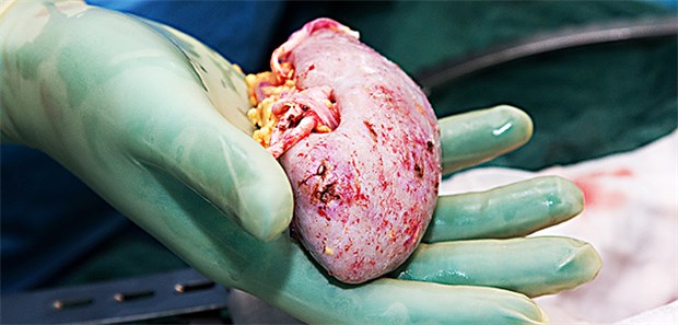 Neuregelungen zur Organspende beschlossen Das gespendete Organ für einen Nierenkranken: Die Zahl der Organspender in Deutschland hat einen Tiefpunkt erreicht.