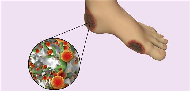Das häufig alkalische Milieu in chronischen Wunden von Diabetikern bietet für viele Bakterien einen idealen Nährboden.