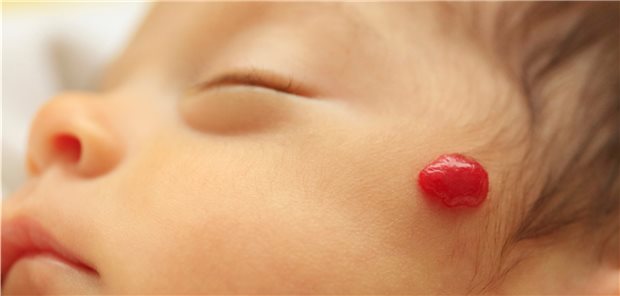 Das infantile Hämangiom ist der häufigste benigne Tumor im frühen Kindesalter.