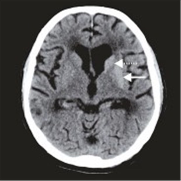 Heftige Armbewegungen - durch Diabetes Das kranielle CT zeigt einen hyperintensen Caput nucleus caudatus (gestrichelter Pfeil) und lentiformis (durchgezogener Pfeil). © (2) Dr. Niels Hansen, Uniklinik Würzburg