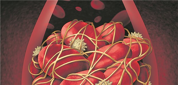 Das kumulative TVT-Risiko zehn Jahre nach einem thrombotischen Ereignis liegt im Mittel bei 30 Prozent.