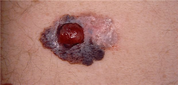 Ein schwarzer Hautkrebs.