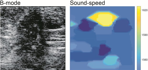 Brustkrebs besser aufspüren mit neuer Ultraschall-Methode Das neue Ultraschallverfahren zeigt ein Mammakarzinom ganz deutlich in Gelb (Bild rechts). Links das schwerer zu deutende herkömmliche Ultraschallbild.