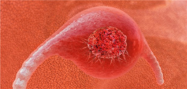 Das neue, organisierte Zervixkarzinom-Früherkennungsprogrammm soll mithelfen, Gebärmutterhalskrebs frühzeitig aufzuspüren.