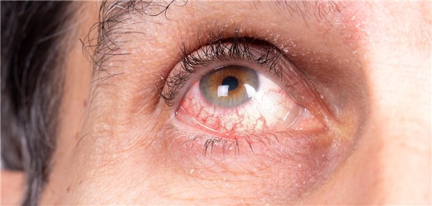 Auge eines an Uveitis erkrankten Mannes mit auffälliger Rötung der Sklera aufgrund gereizter Kapillaren.