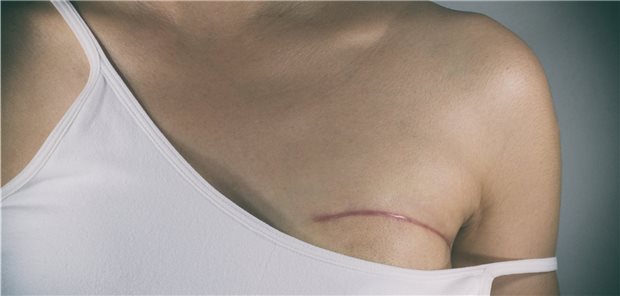 Das strukturierte Versorgungsprogramm für Brustkrebspatientinnen beinhaltet mehrere messbare Qualitätsziele. Im Jahr 2019 erreichten die niedergelassenen Ärzte diese bei ihren in das entsprechende DMP  eingeschriebenen Patientinnen in unterschiedlichem Ausmaß.