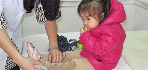 Die vergessenen Opfer Das zweieinhalbjährige Mädchen Hai Yen wird in einem Orthopädiezentrum in Hanoi in Vietnam behandelt. Die Kleine ist ein Opfer von Agent Orange - ihr linkes Bein ist verkrüppelt.