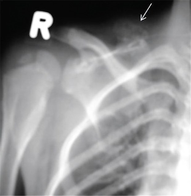 Multiple Osteochondrome bei 6-Jährigem Dasselbe Kind wie oben. Röntgenaufnahme des Schulterbereiches mit der Exostose.
