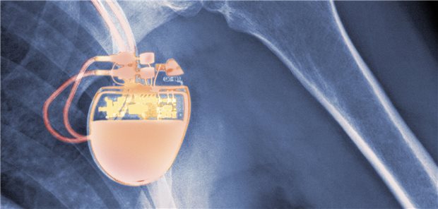 Alle Kassen sollen Transmitter für Telekardiologie erstatten Defibrilator-Implantat: In Deutschland erfolgt erst bei rund einem Fünftel aller Träger die Funktionsprüfung per Datenfernübertragung.