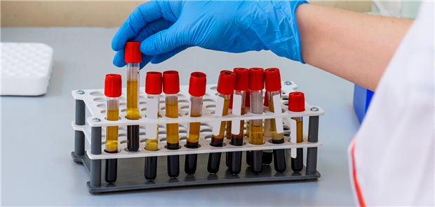 Hände eines Laboranten in Handschuhen bei der Analyse einer Blutplasmaprobe.