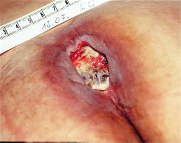 Biochirurgische Therapie mit Maden beseitigt Nekrosen und Infektion Dekubitus im Bereich des Os sacrum bei einem bettlägerigen Patienten.
