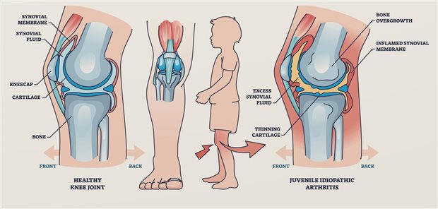 Dem Kinderrheumatologen Professor Gerd Honeff zufolge, ist eine Biomarker gesteuerte Absetzstrategie für Kinder mit juveniler idiopathischer Arthritis (JIA) in Remission in der klinischen Praxis umsetzbar und mit einem direkten Nutzen für Patientinnen und Patienten verbunden.