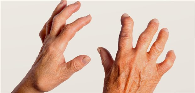 Von Fingerpolyarthrose deformierte Hände.