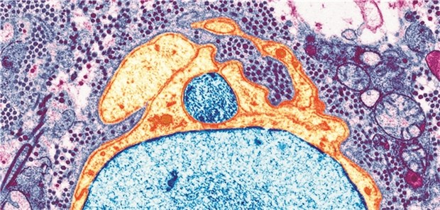 Erste krankheitsmodifizierende Therapie bei primär progredienter MS Demyelinisierte Nervenzelle bei Multipler Sklerose. Folge sind etwa Sehstörungen, oft erster Hinweis auf eine MS.