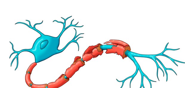 Demyelinisierung einer Nervenzelle: Für Patienten mit sekundär-progredienter MS gibt es bislang praktisch keine wirksamen Therapien.