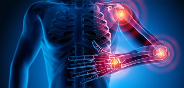 Dreidimensionale Illustration eines menschlichen Torso eines Patienten mit Rheuma mit Markierungen der potentiellen Schmerzpunkte im Schulter-, Ellenbogen- oder Handgelenk.