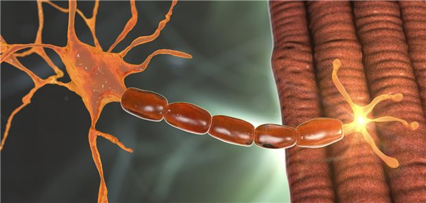 Den Symptomen bei Myasthenia gravis liegt eine neuromuskuläre Übertragungsstörung zugrunde.
