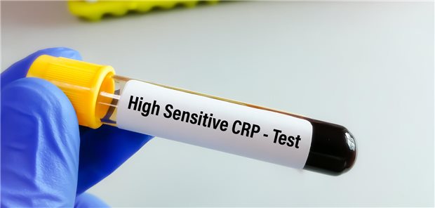 Laborant hält Blutprobenröhrchen für den hs-CRP-Test (hochsensibles CRP) zur Risikoeinschätzung von retinalen Arterienverschlussen und von Schlaganfällen bei einem Patienten in der Hand.