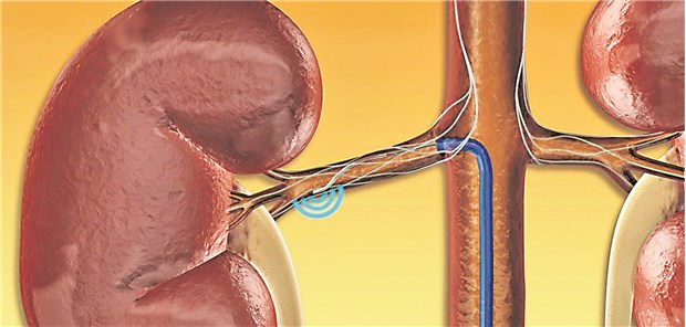 Denervation: Mit einem Katheter werden Nervenbahnen in den Wänden der Nierenarterien verödet.