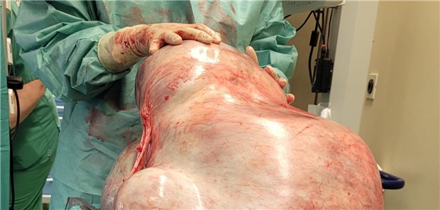 Universitätsfrauenklinik Magdeburg: Riesiger Tumor aus Eierstöcken entfernt Der 32 kg schwere Tumor nach der Resektion.