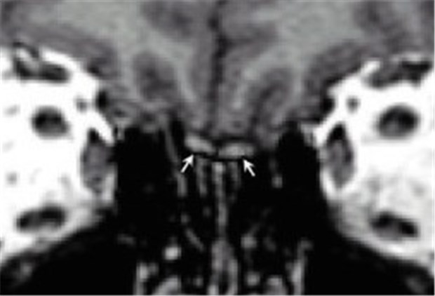 Alzheimer-Diagnostik am Riechkolben Der Bulbus olfactorius (Pfeile) im MRT.