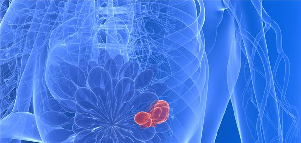 Der CDK4/6-Inhibitor Abemaciclib kommt auch für die adjuvante Brustkrebstherapie bei hohem Rezidivrisiko in Frage.