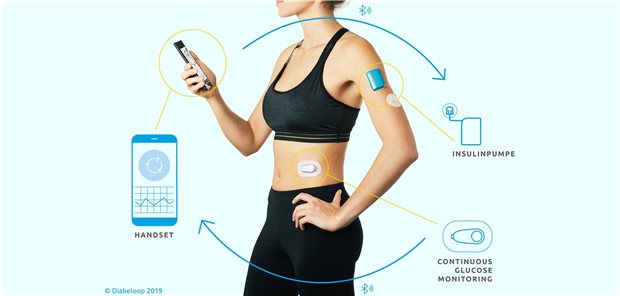 Der Dexcom-Glukosesensor: Hier kombiniert mit einer Patch-Insulinpumpe und einer Steuereinheit von Diabeloop.
