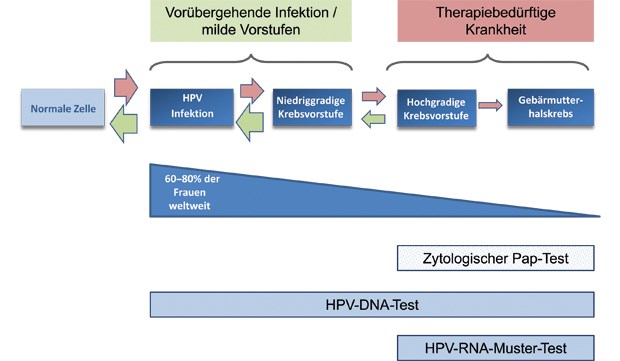 Hochgradige Krebsvorstufen bei Zervix-Ca identifizierbar Der HPV-RNA-Muster-Test ergänzt den HPV-DNA-Test und den zytologischen Pap-Test bei hochgradigen Krebsvorstufen oder bei Gebärmutterhalskrebs. Mit dem HPV-RNA-Muster-Test wird ein breites Spektrum an RNA-Transkripten abgetastet. Es lassen sich damit Marker für hochgradige Läsionen und Karzinome finden.