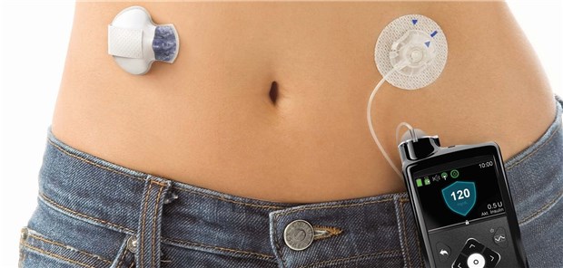 Der Hybrid „closed loop“ MiniMed™ 670G mit Insulinpumpe und Sensor zur kontinuierlichen Glukosemessung.