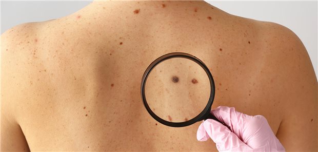 Ein Dermatologe untersucht die Muttermalen eines Patienten mit Hilfe eines Vergrößerungsglases.