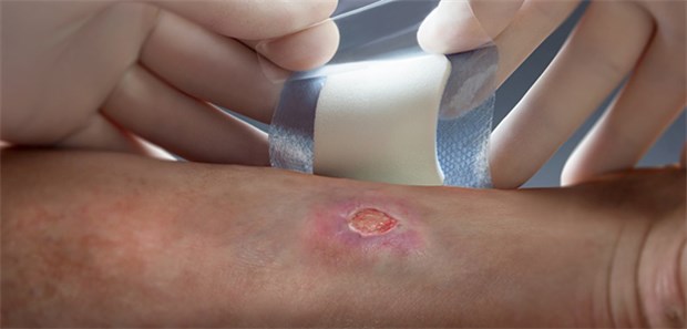 Wundmanagement statt nur Versorgung Der Leidensweg von Patienten mit Ulcus cruris venosum ist oft lang.